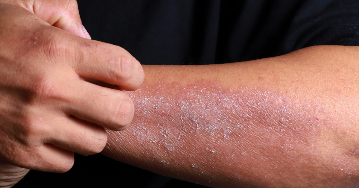 Vicharchika (eczema) and Ayurvedic purification-based management strategies